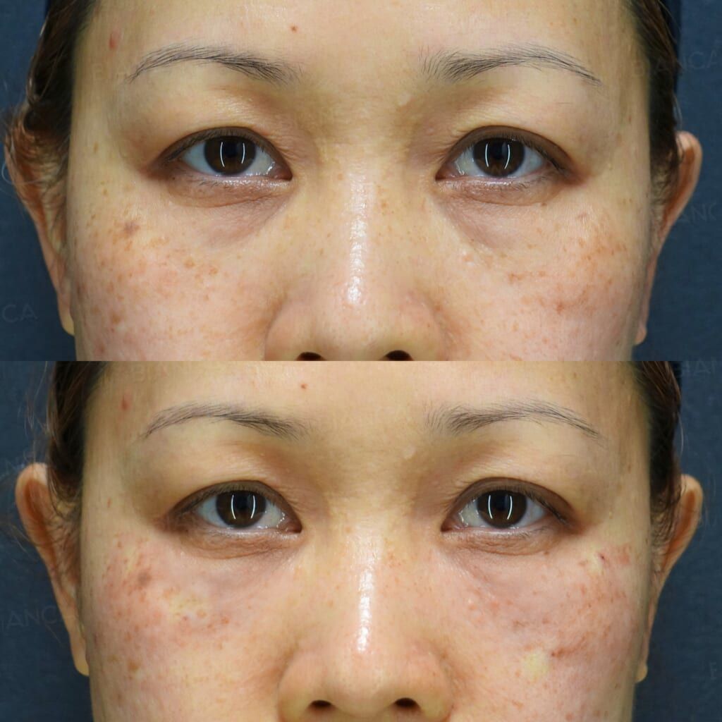 Baby Collagen (Under Eyes)