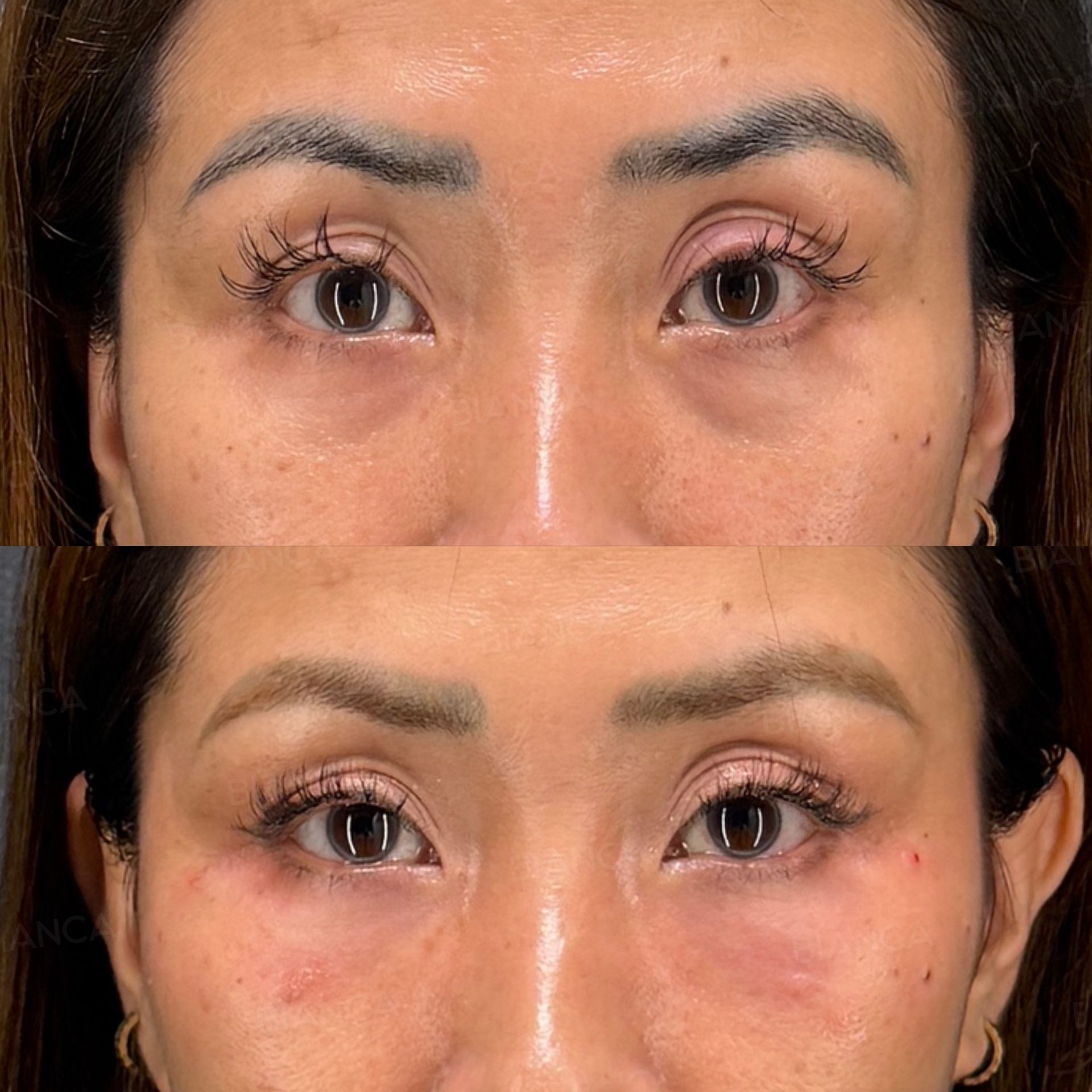 Baby collagen injection before and after cannula placement under the eyes from a single entry point at the outer corner, front view immediately after treatment