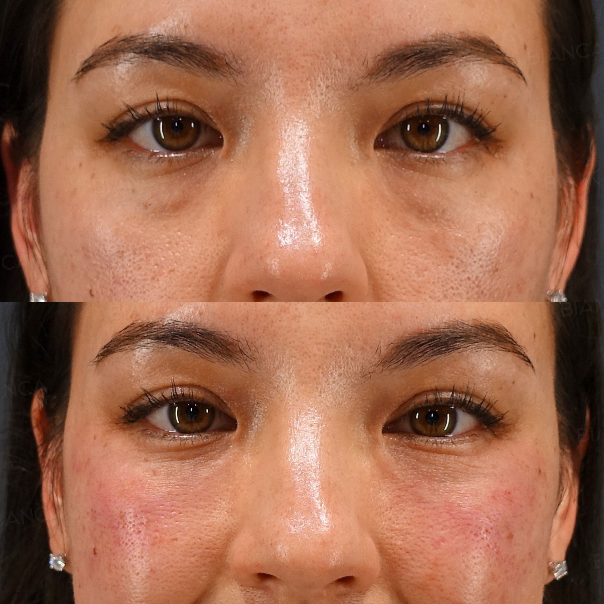 Baby collagen injection before and after under eye filling with Nabota botulinum toxin at the crow's feet, front view, immediately after treatment