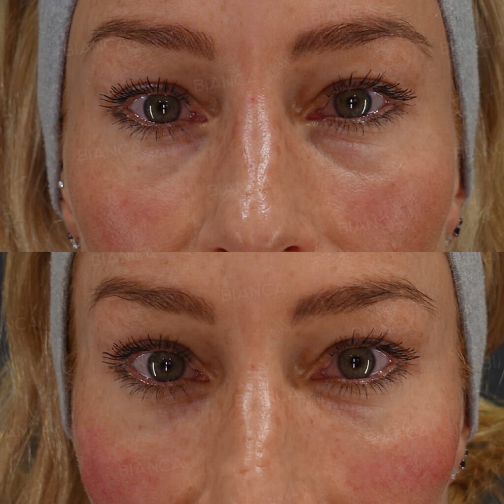 Baby Collagen (Under Eyes), Botox Injection (Periorbital Area, Forehead: Allergan)
