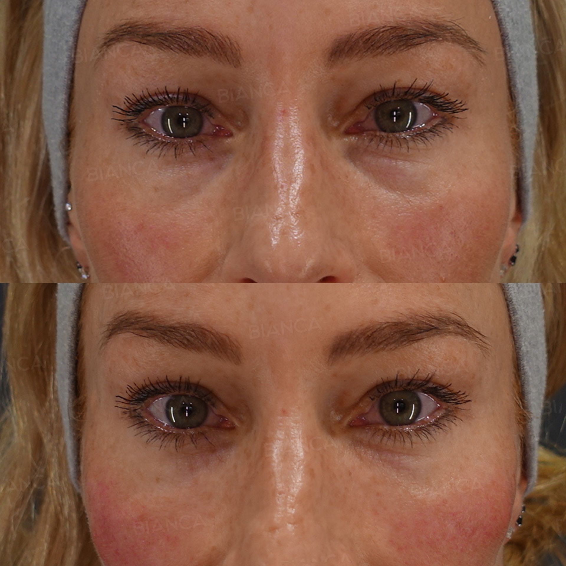 Baby Collagen (Under Eyes), Botox Injection (Periorbital Area, Forehead: Allergan)
