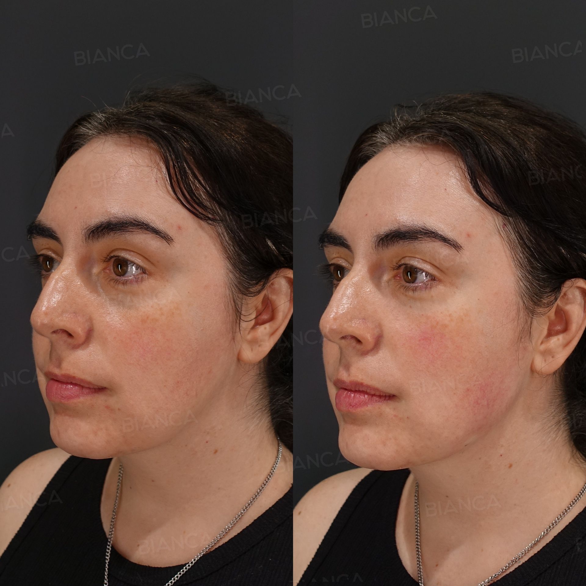 Baby collagen injection before and after treatment under the eyes with NEAUVIA INTENSE hyaluronic acid along the jawline, three-quarter view at 2 weeks