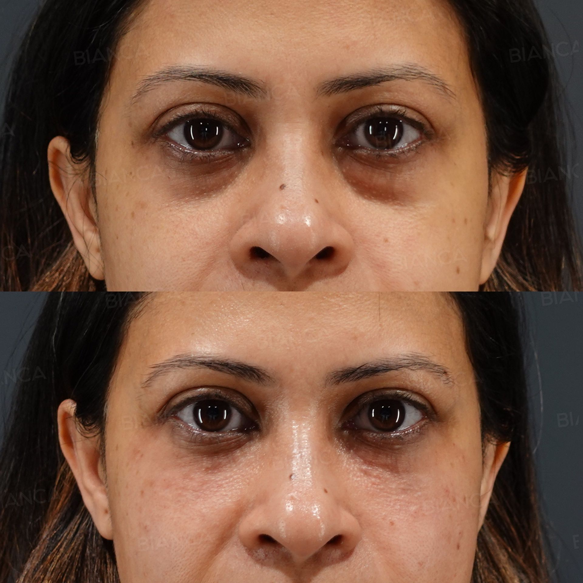 Baby Collagen (Under Eyes), Hyaluronic Acid Injection (Midcheek Groove: Juvederm VOLUMA XC)