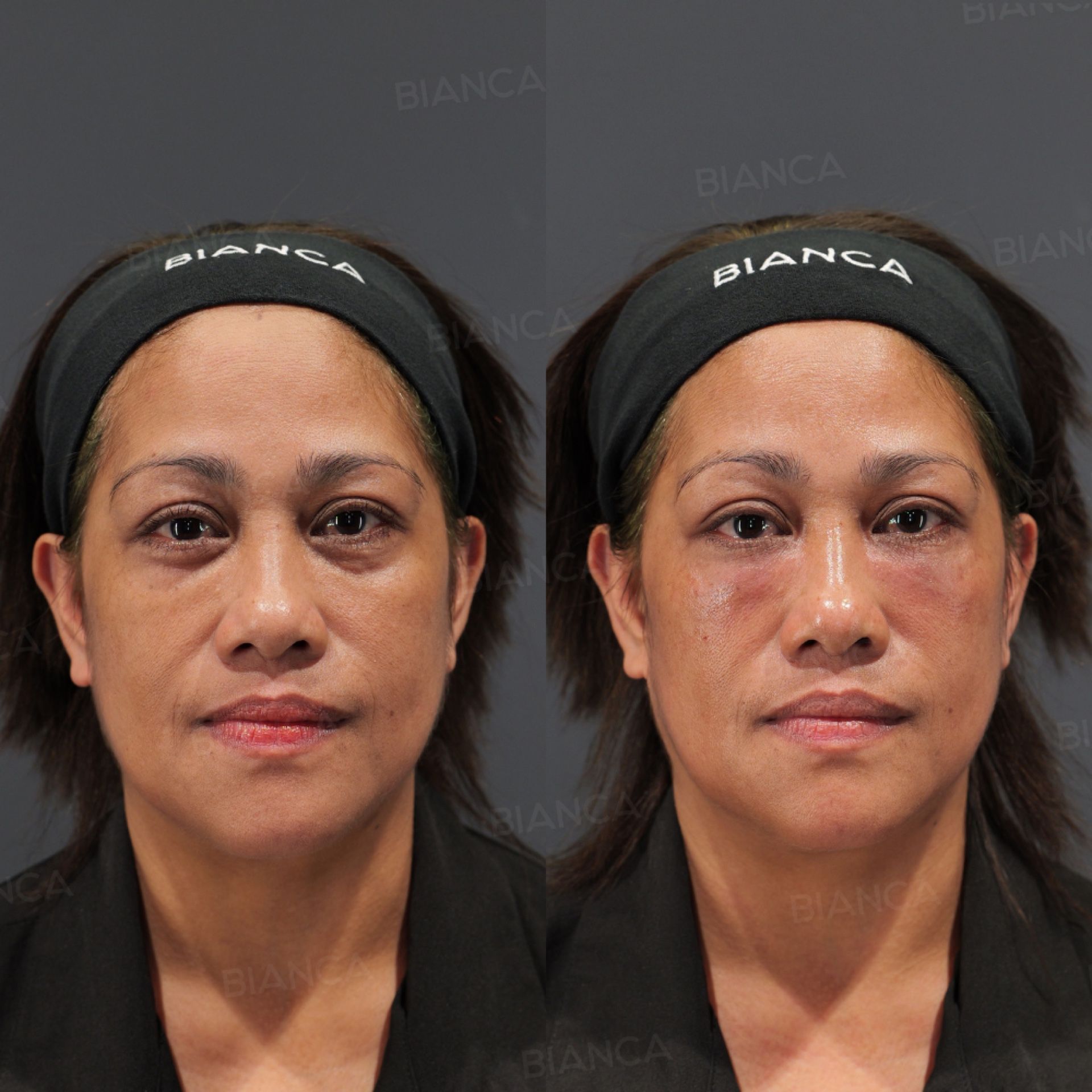 Baby collagen injection before and after under-eye treatment with Teosyal RHA 3 placed deep in the tear trough, front view immediately after treatment