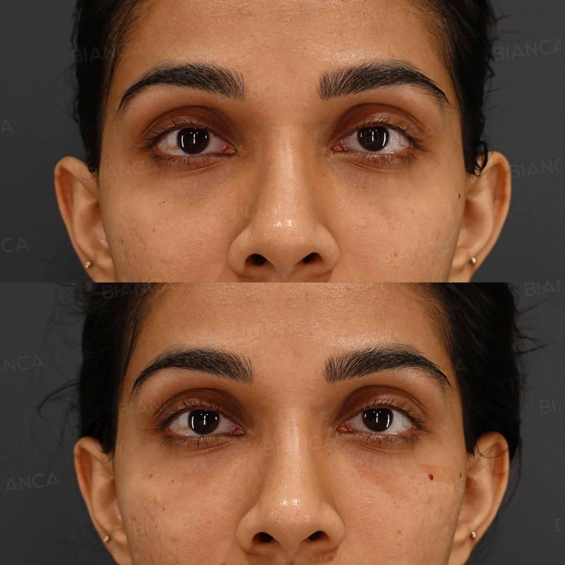 Baby collagen injection before and after under-eye treatment with Juvelook, Rejuran and botulinum toxin in the same plan, front view immediately after treatment