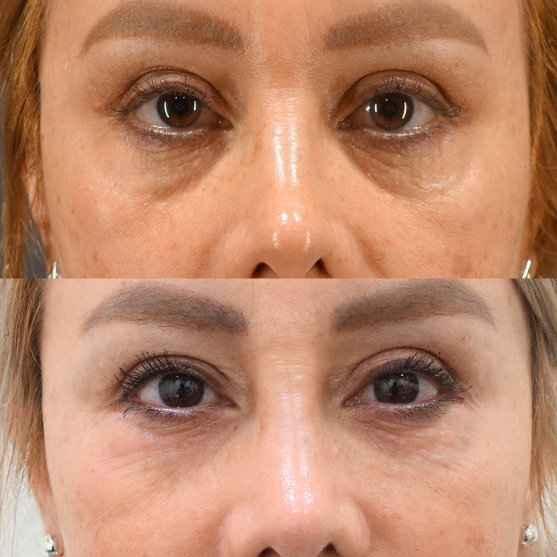 Baby Collagen (Under Eyes), Pico Spot (Full Face), Rejuran i