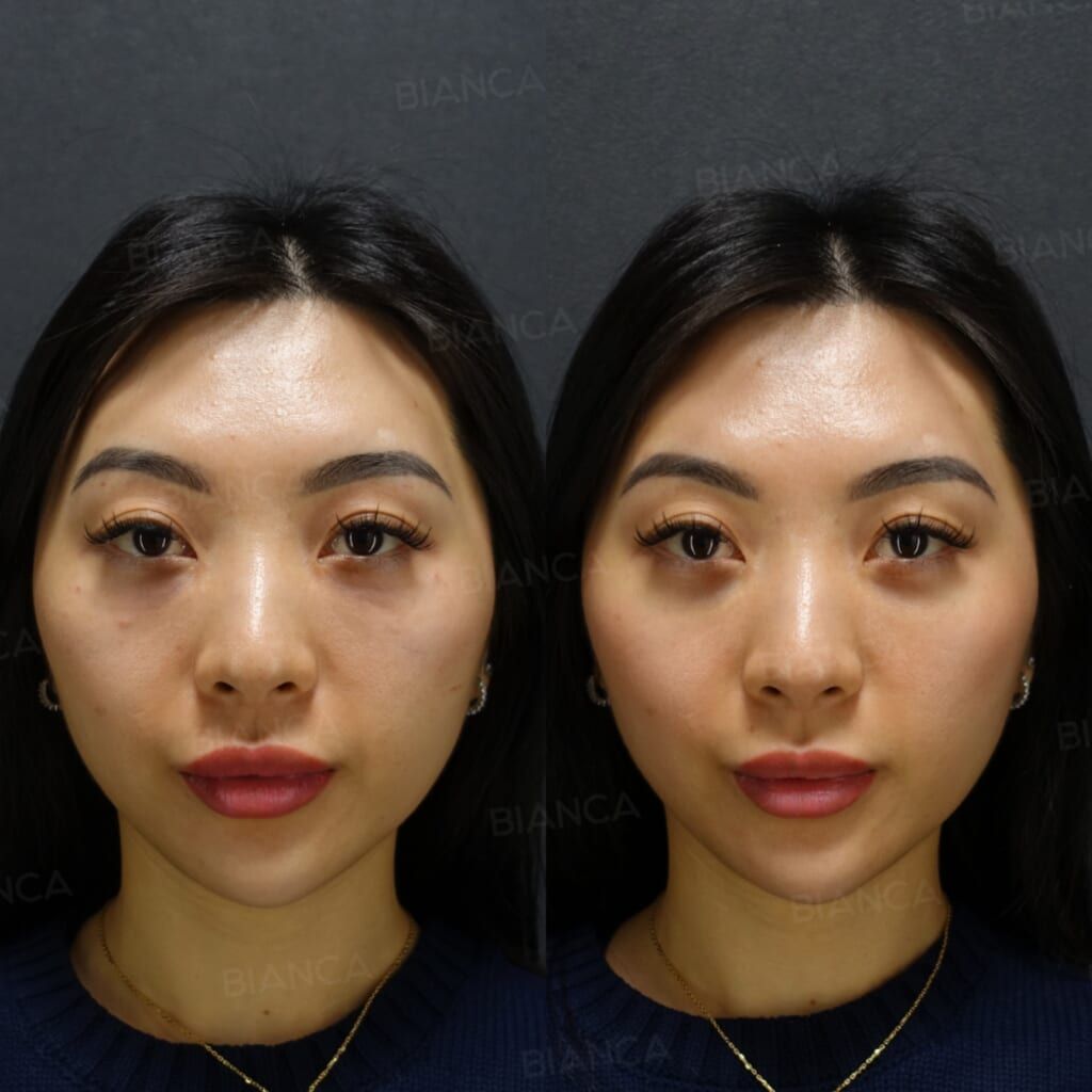 Baby Derm (Under Eyes)