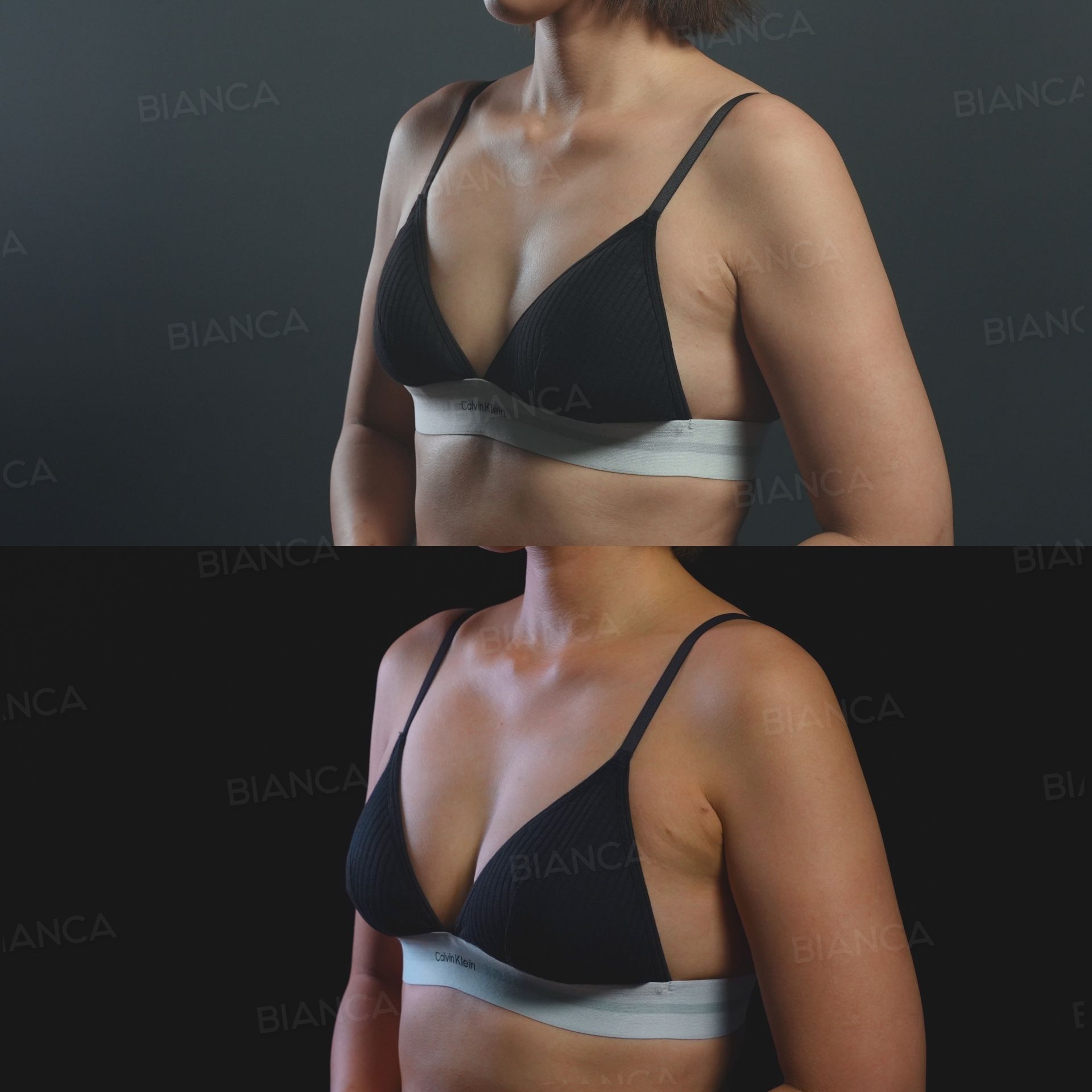 Breast augmentation before and after BeautiFill laser assisted fat transfer performed without an implant