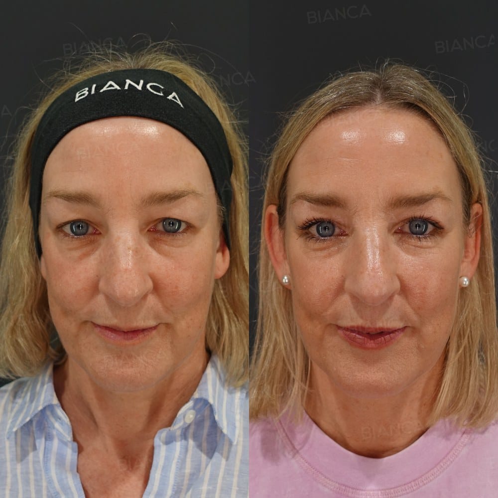 Bilateral Upper Eyelid Blepharoplasty before and after, 1 month, BIANCA CLINIC Tokyo