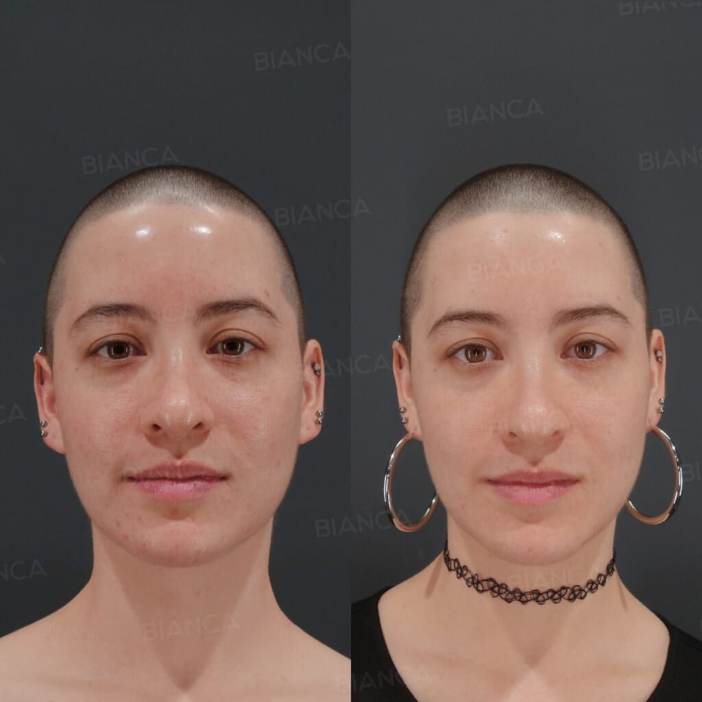 Botox Injection (Forehead, Chin: Allergan)
