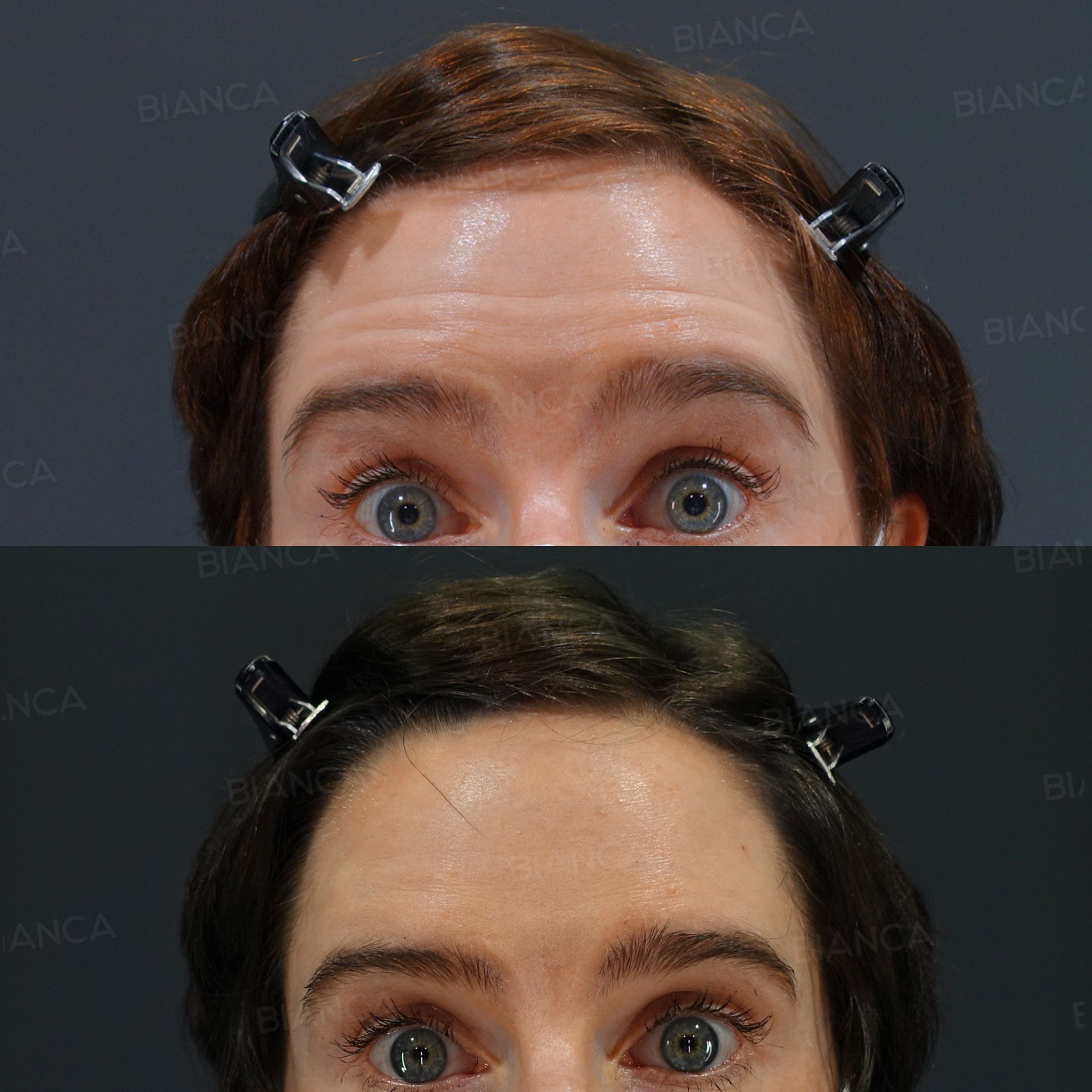 Botox Injection (Forehead: Coretox)