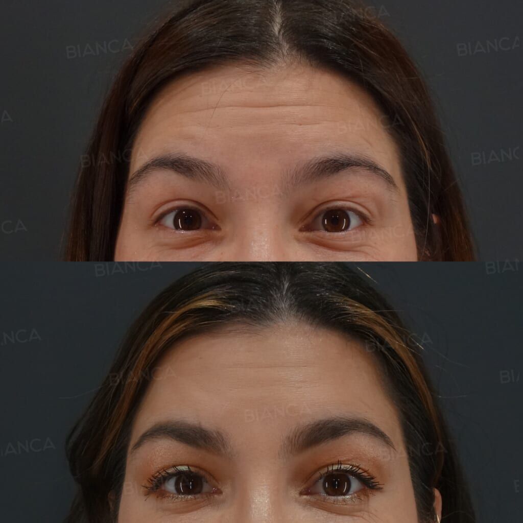Botox Injection (Forehead, Glabella, Crow’s Feet, Above the Eyebrows: Allergan)