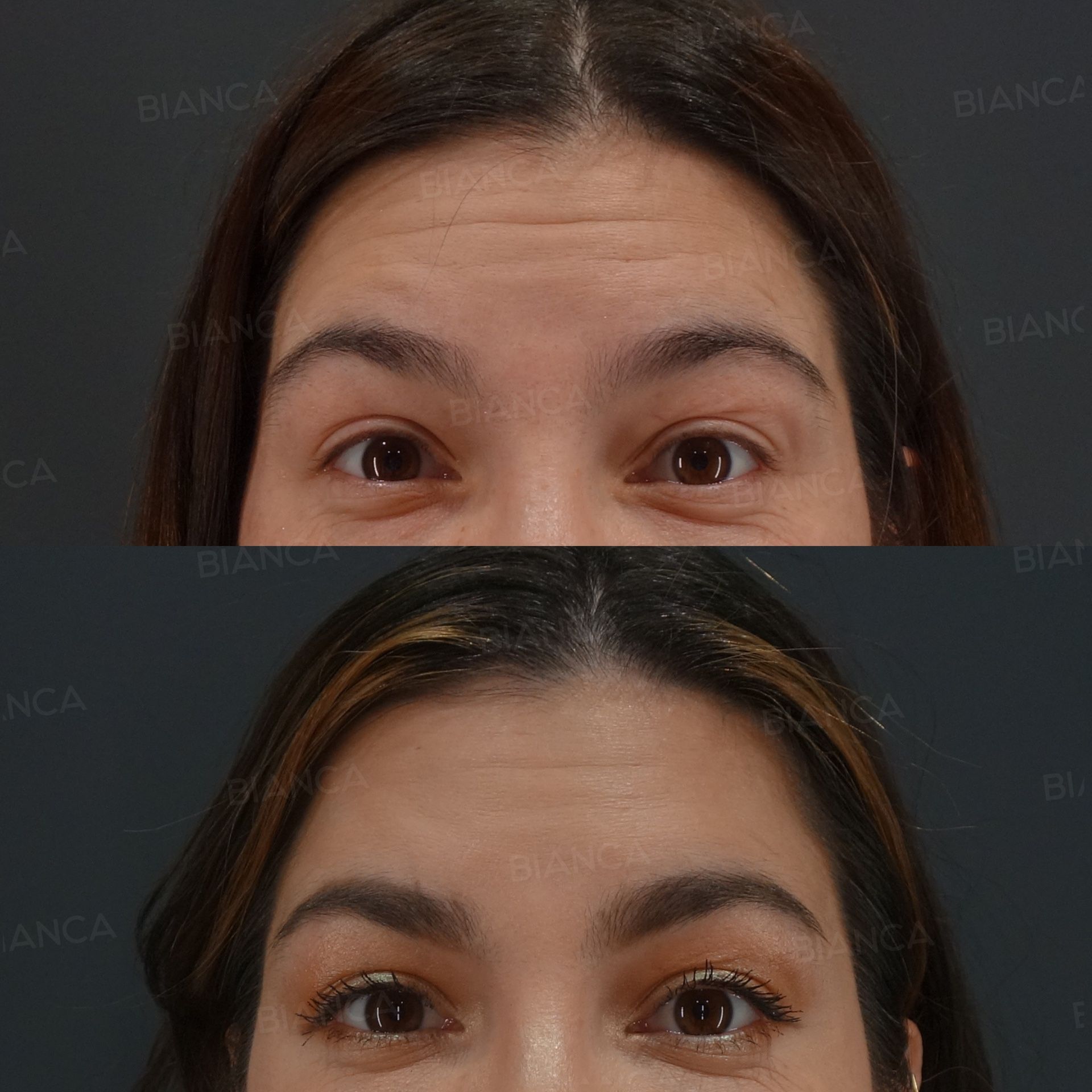 Botox injection before and after Allergan botulinum toxin in the forehead, glabella, crow's feet and above the eyebrows, front view at 1 month