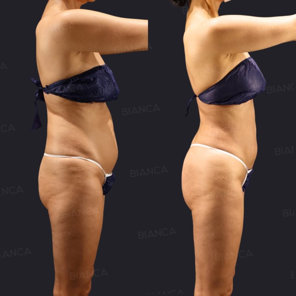 Brazilian Butt Lift (BBL), VASER Liposuction (Love Handles, Waist), EmbraceRF (Body), Morpheus8 (Body)
