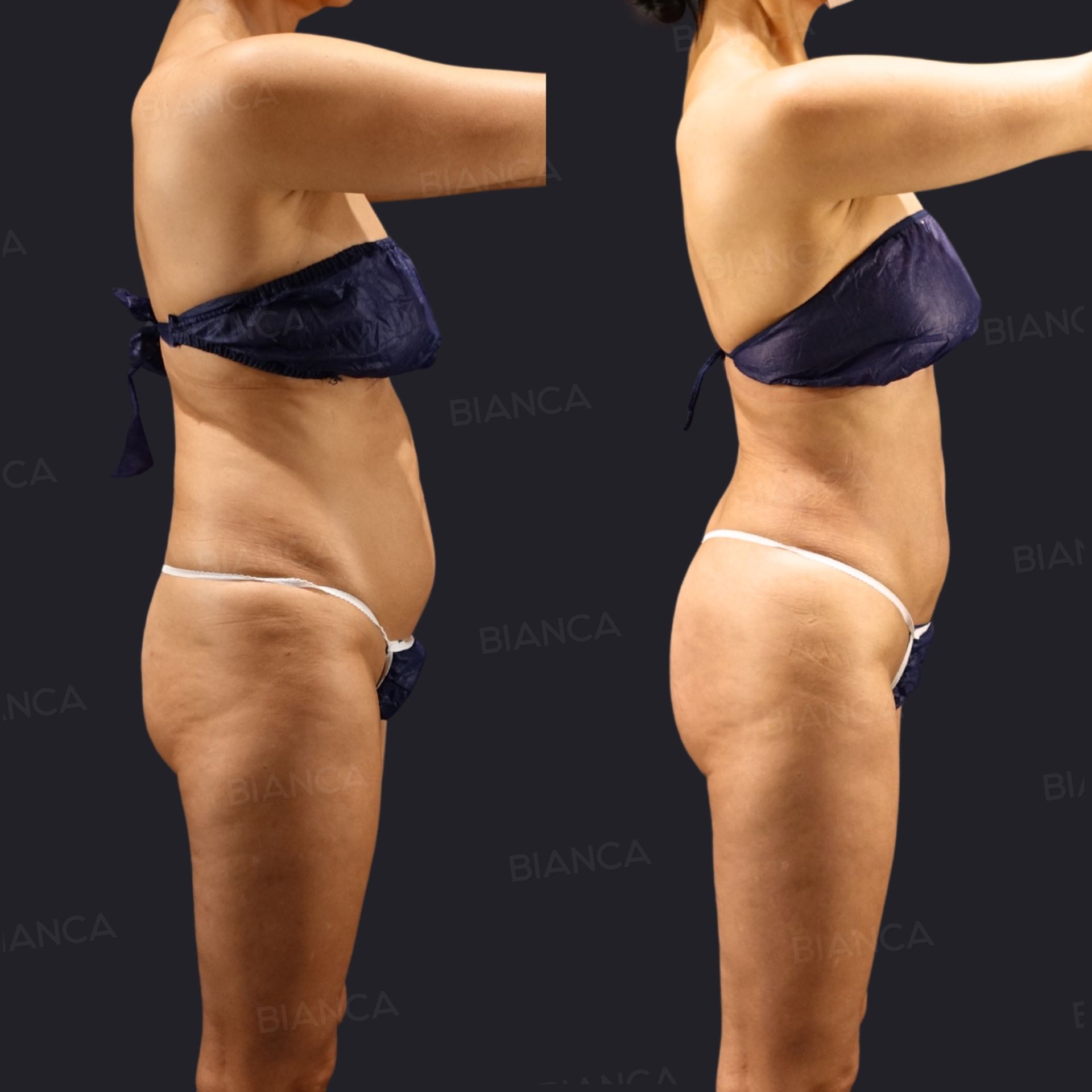 Brazilian Butt Lift (BBL), VASER Liposuction (Love Handles, Waist), EmbraceRF (Body), Morpheus8 (Body)