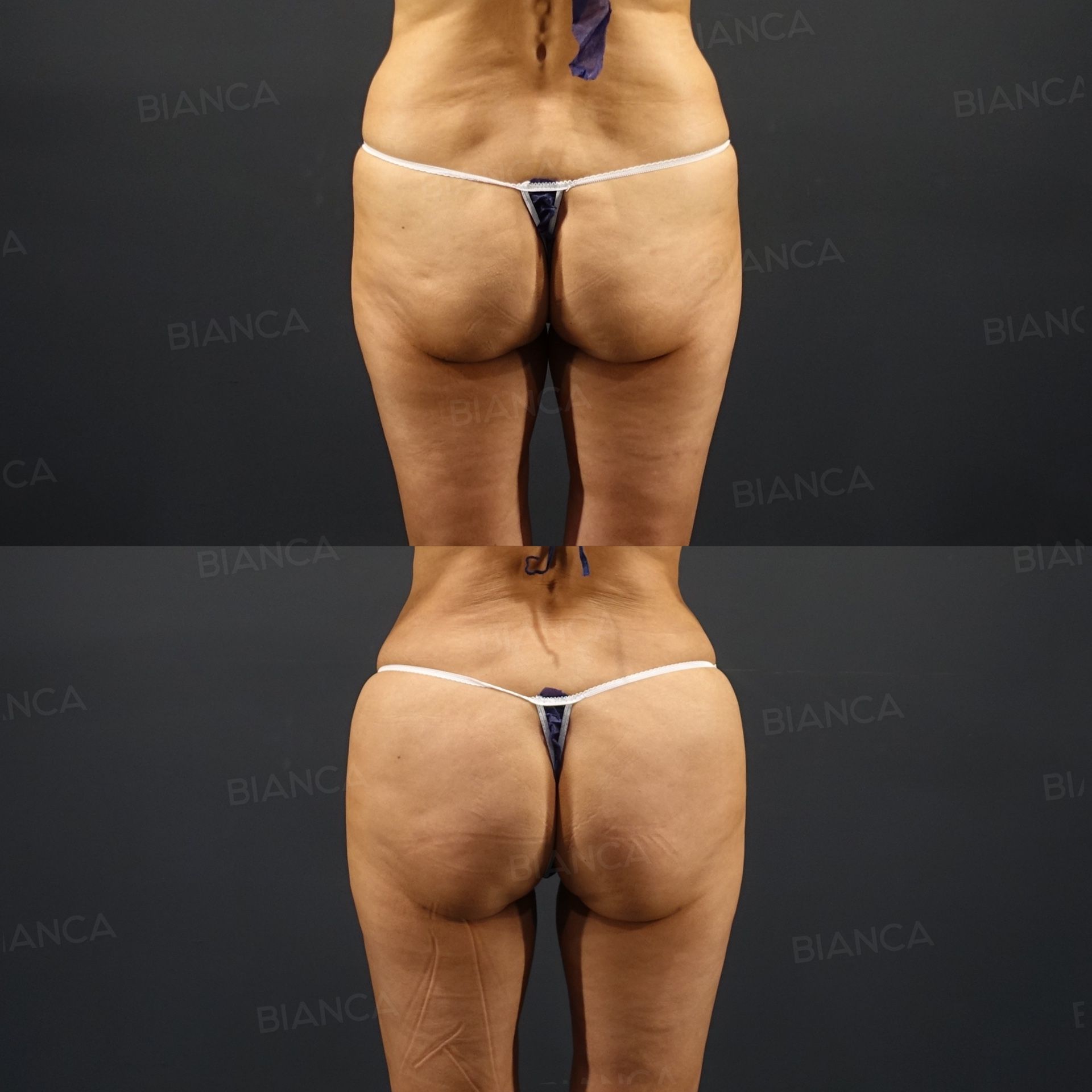 Brazilian Butt Lift (BBL), VASER Liposuction (Love Handles, Waist), EmbraceRF (Body), Morpheus8 (Body)