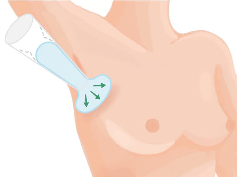 Diagram illustrating breast augmentation with silicone implant insertion