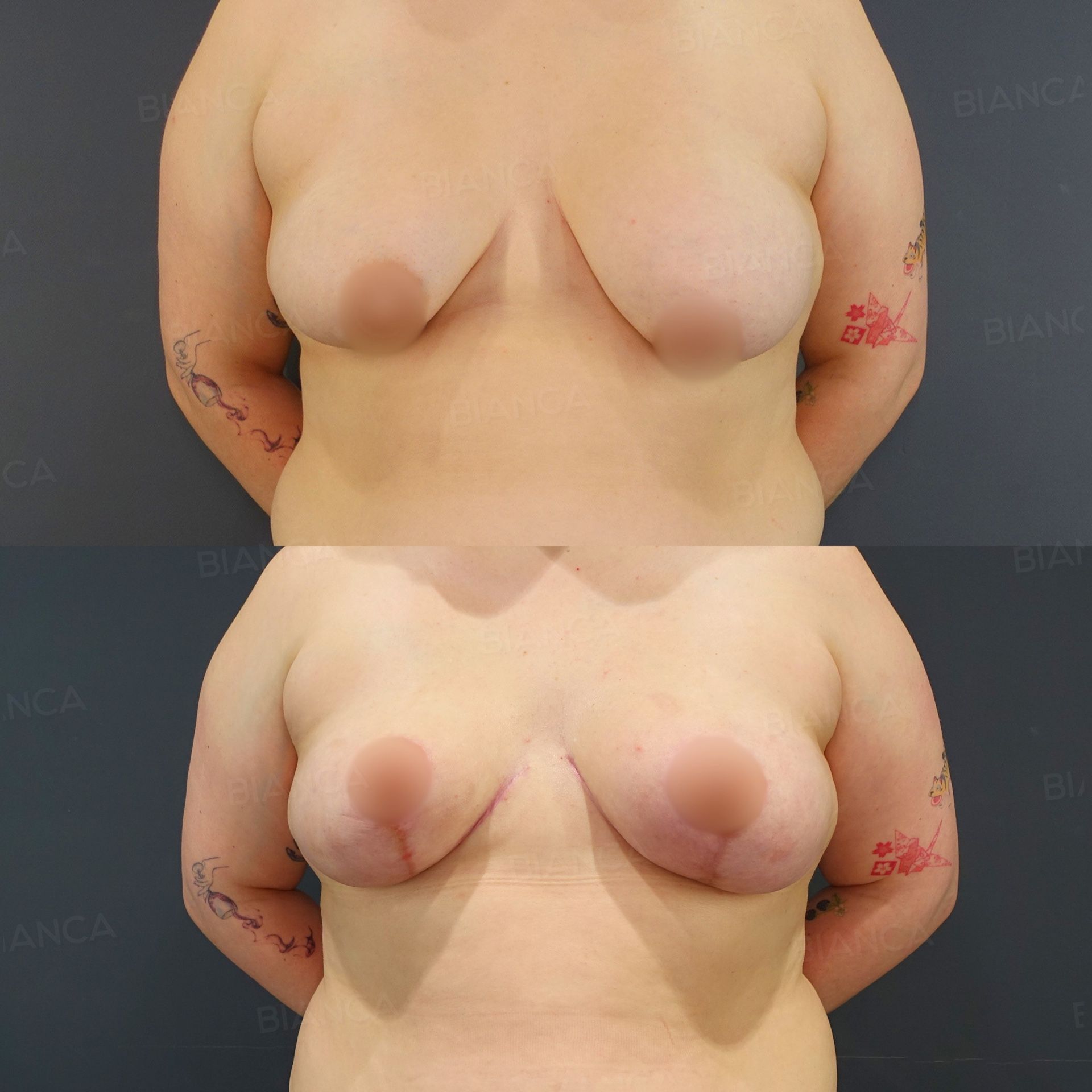 Breast lift before and after mastopexy raising the breast and repositioning the nipple without an implant at 4 months