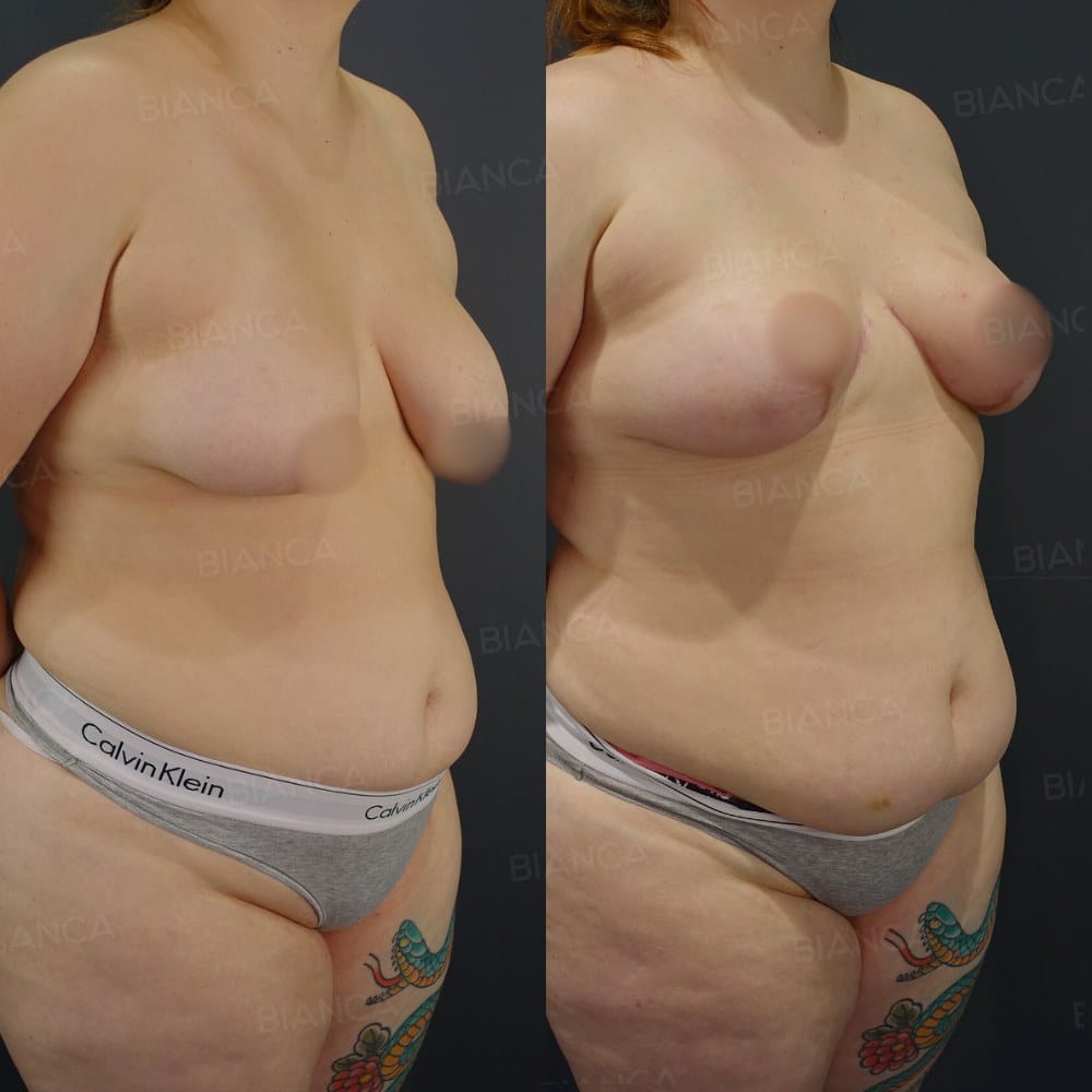 Breast Lift (Mastopexy) before and after, 6 months, BIANCA CLINIC Tokyo