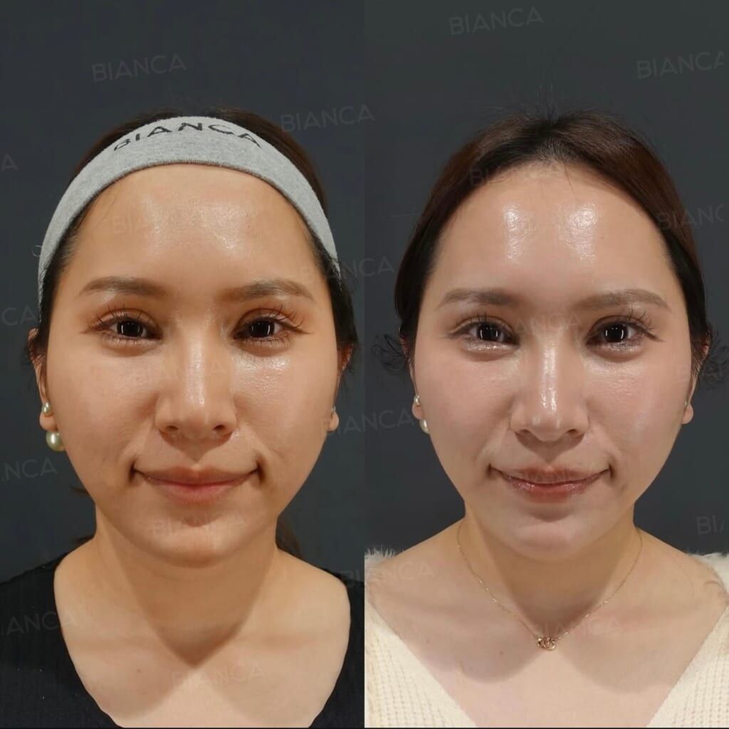 Buccal Fat Removal, Thread Lift