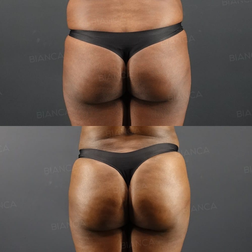 Butt Augmentation (Brazilian Butt Lift) before and after, 3 months, BIANCA CLINIC Tokyo