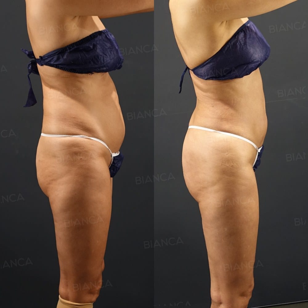Butt Augmentation (Brazilian Butt Lift) before and after, 3 months, BIANCA CLINIC Tokyo