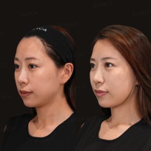 CaHA skin boost before and after hyperdilute calcium hydroxylapatite injection to stimulate collagen, three-quarter view, immediately after treatment