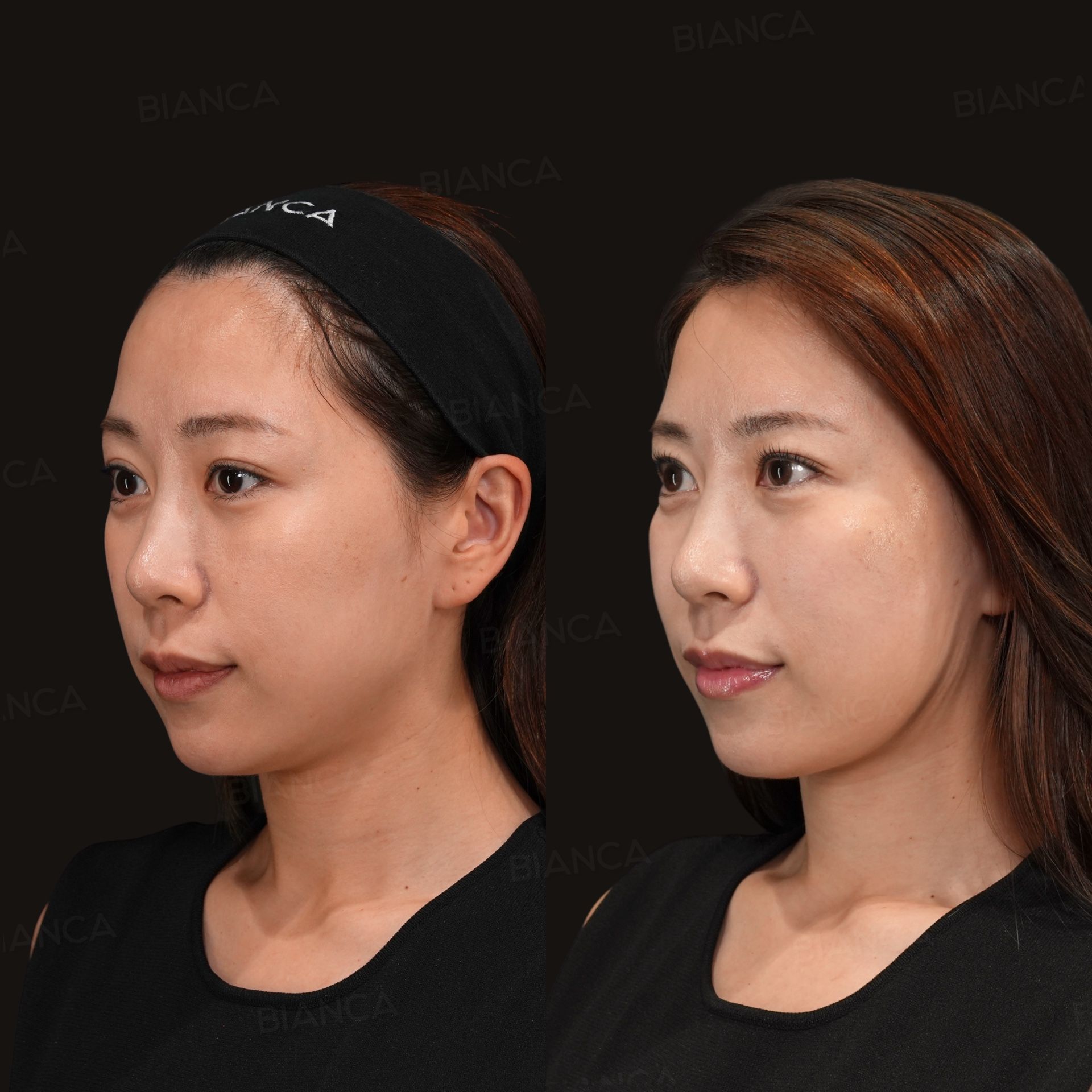 CaHA skin boost before and after hyperdilute calcium hydroxylapatite injection to stimulate collagen, three-quarter view, immediately after treatment