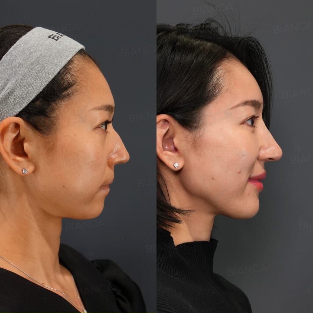 Collagen Boost, Buccal Fat Removal Hyaluronic Acid Injection (Nose, Jawline, Lips) Glamorous Line Formation (Lower Eyelid Opening), Double Eyelid Suture Method Facial Fat Grafting (Forehead, Temples, Under Eyes, Midcheek Groove), NANOSTEM