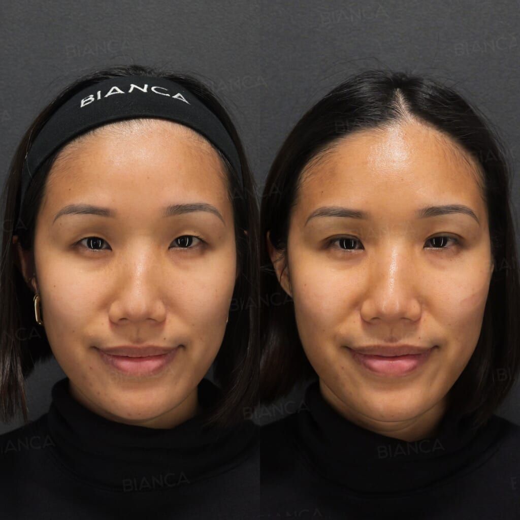Double Eyelid Suture Method (B TWICE)