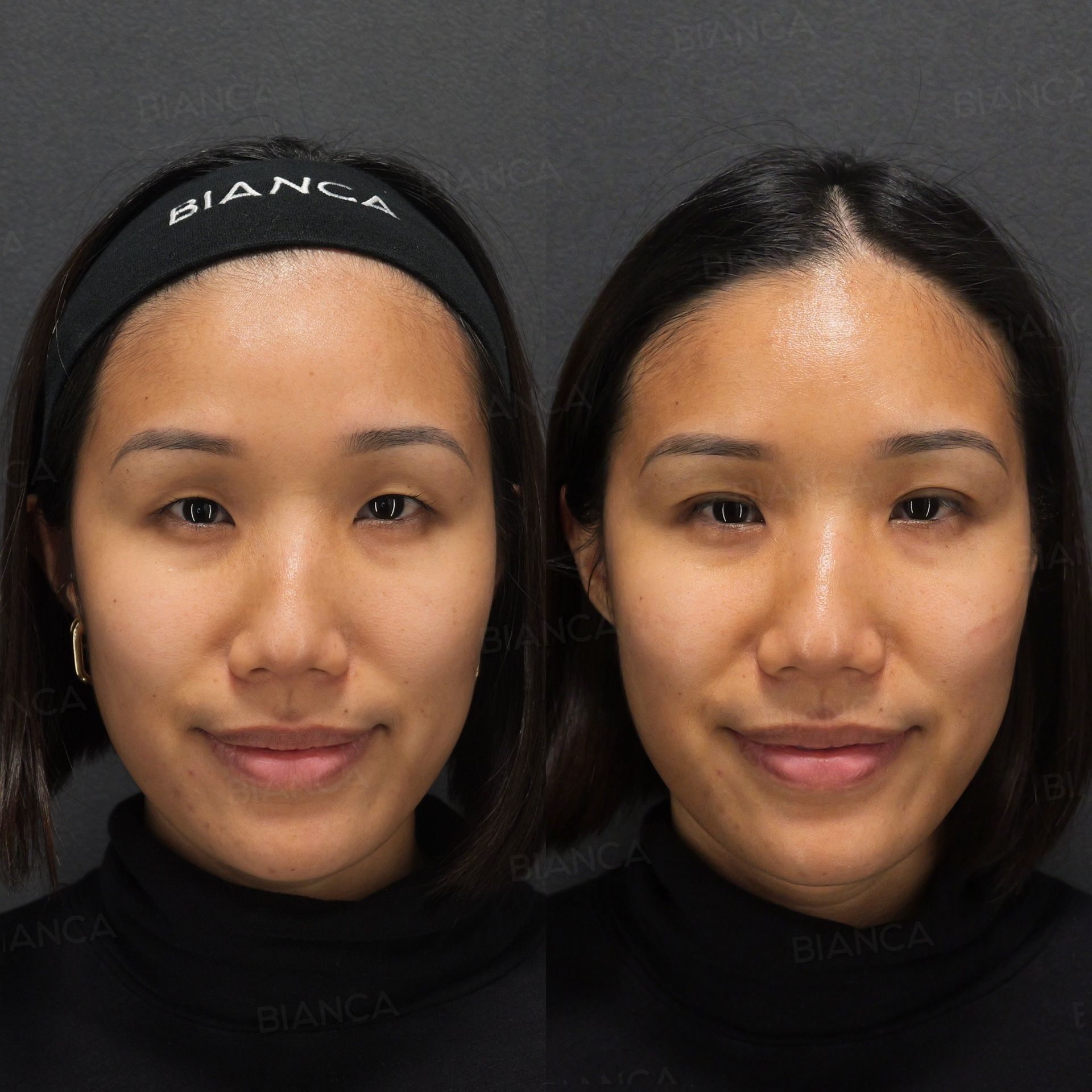 Double Eyelid Suture Method (B TWICE)