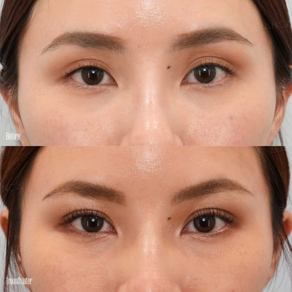 Double Eyelid Suture Method (Natural Adhesion Method)