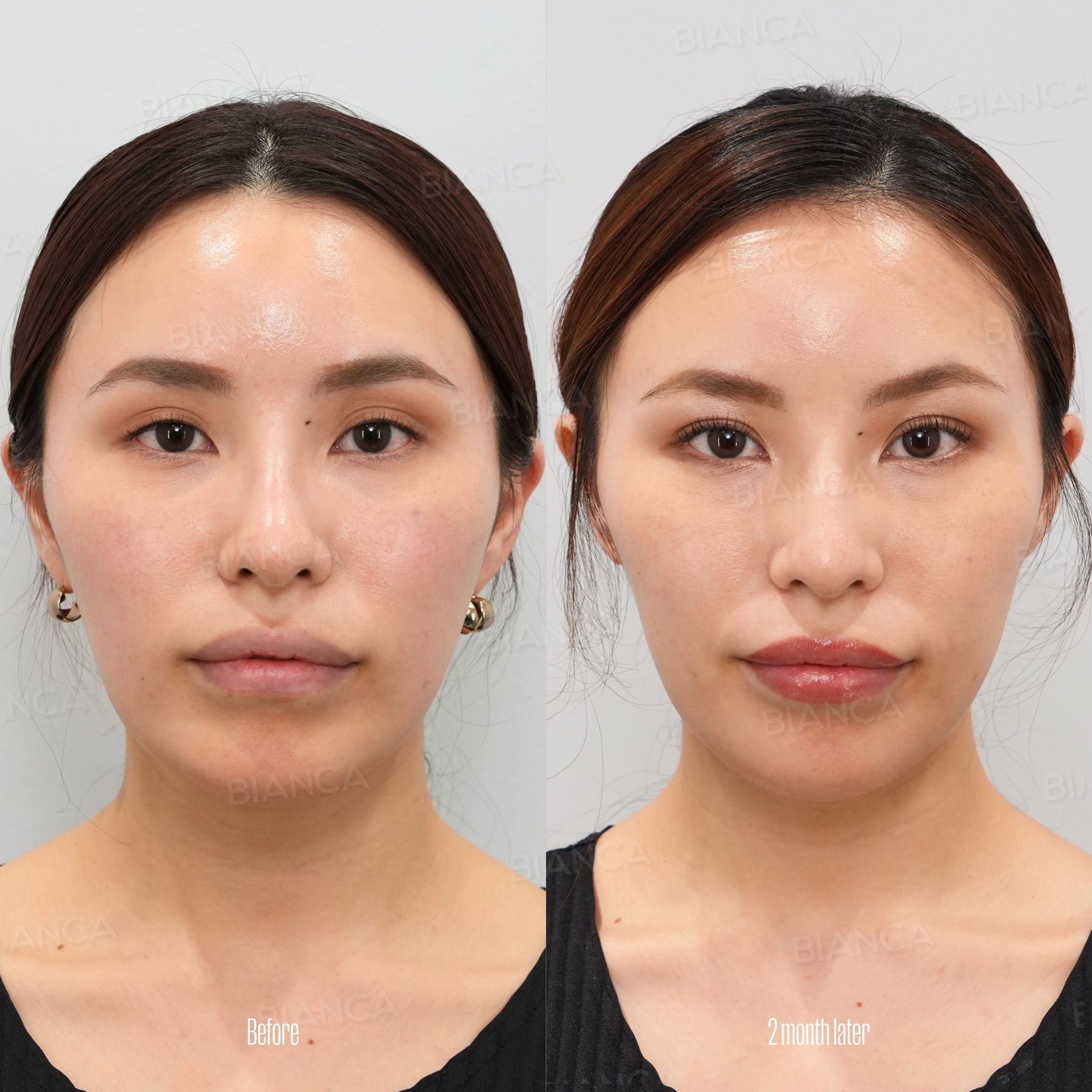 Double eyelid surgery before and after the natural adhesion suture method with the knots hidden and no visible scar, front view of the whole face at 2 months