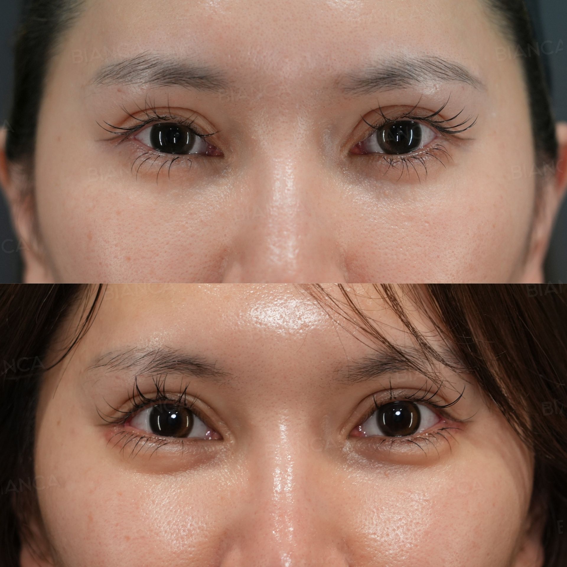 Downward Lateral Canthoplasty