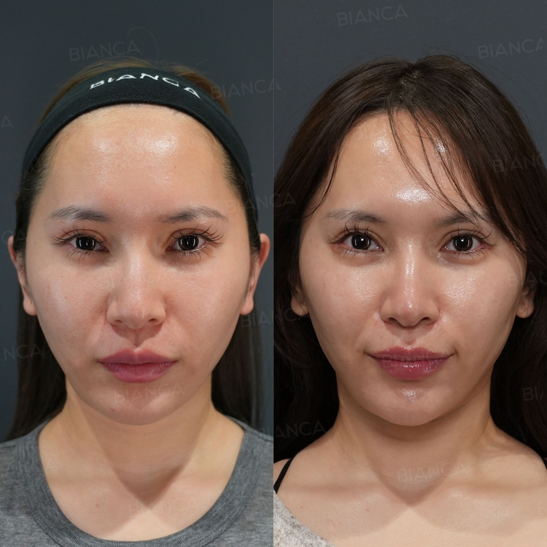 Blepharoplasty before and after downward lateral canthoplasty repositioning the outer corner of the eye, front view of the face at 1 month