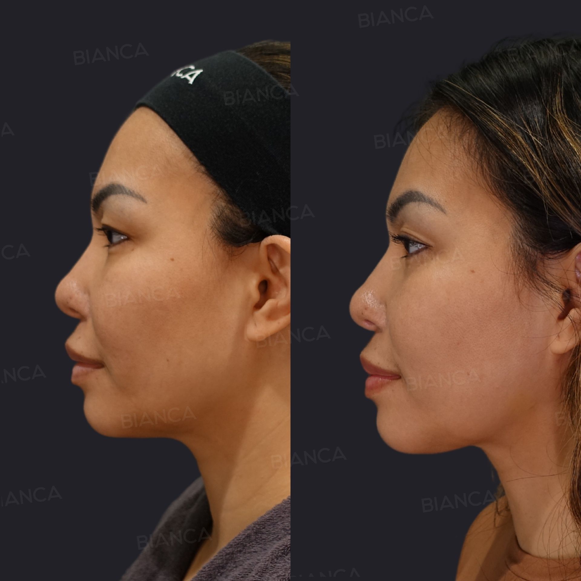 EmbraceRF facial contouring before and after submental liposuction, a BIANCA LIFT thread lift of the jawline and Morpheus8, side view at 3 months