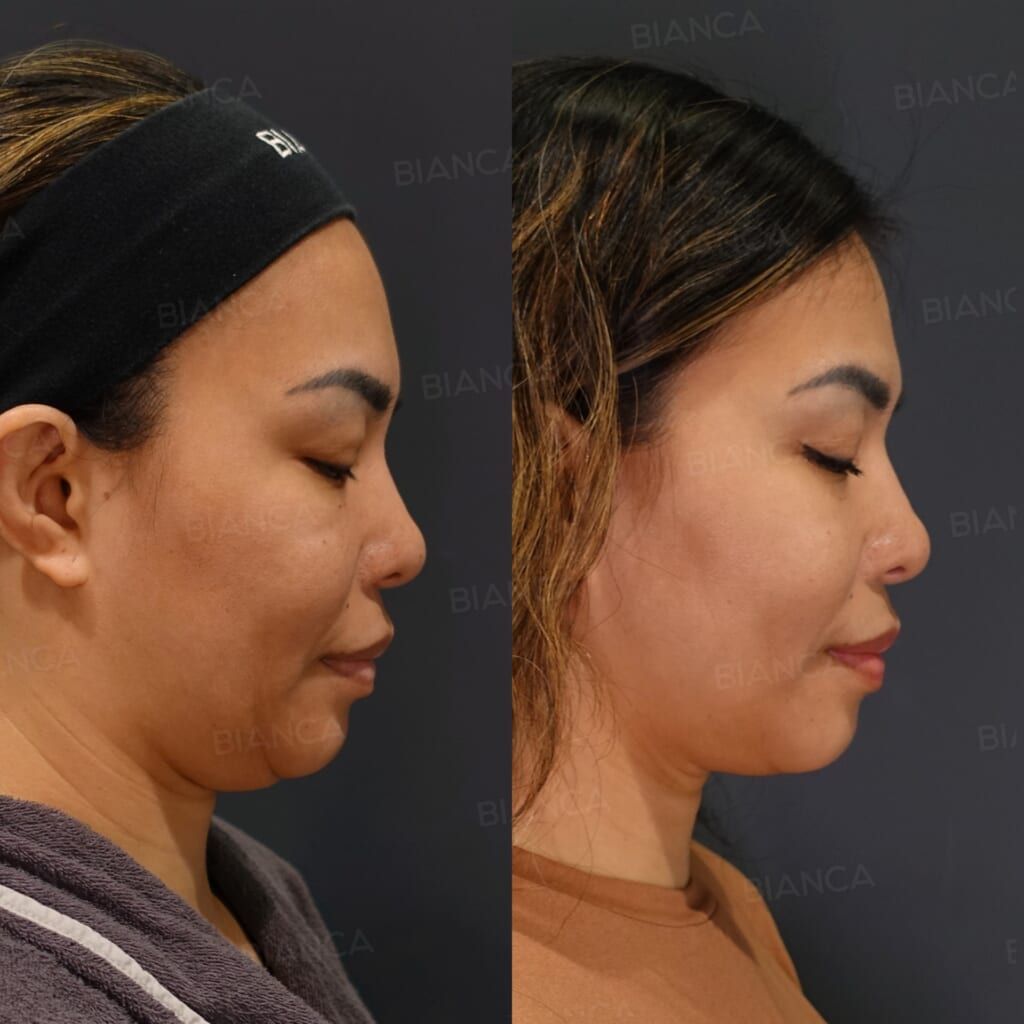 EmbraceRF (Face), Liposuction (Submental), Thread Lift (BIANCA LIFT), Morpheus8