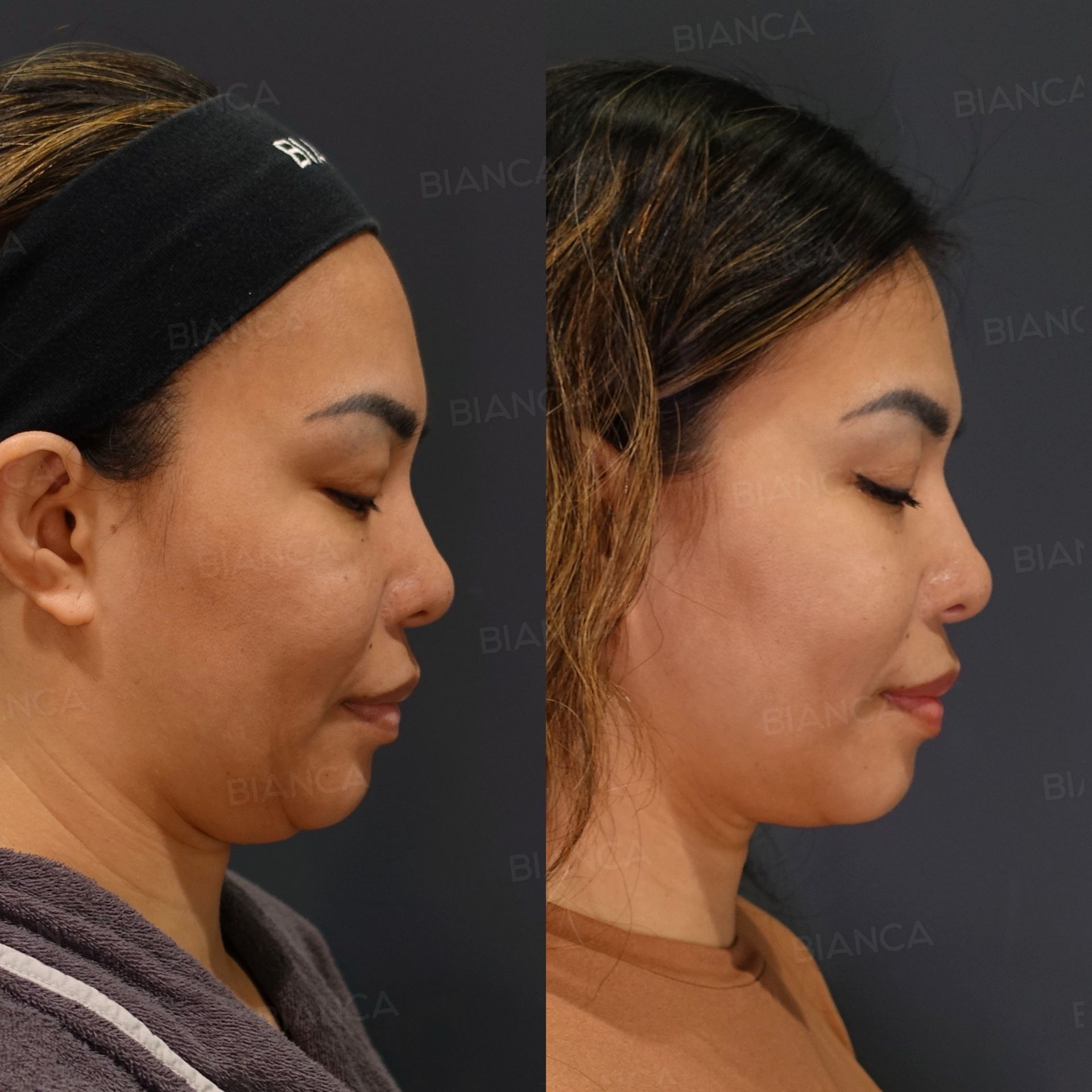 EmbraceRF (Face), Liposuction (Submental), Thread Lift (BIANCA LIFT), Morpheus8