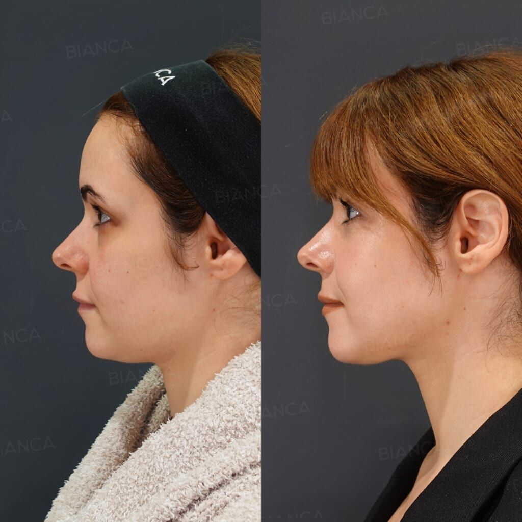 EmbraceRF (Face), Morpheus8 (Submental), Liposuction (Submental)