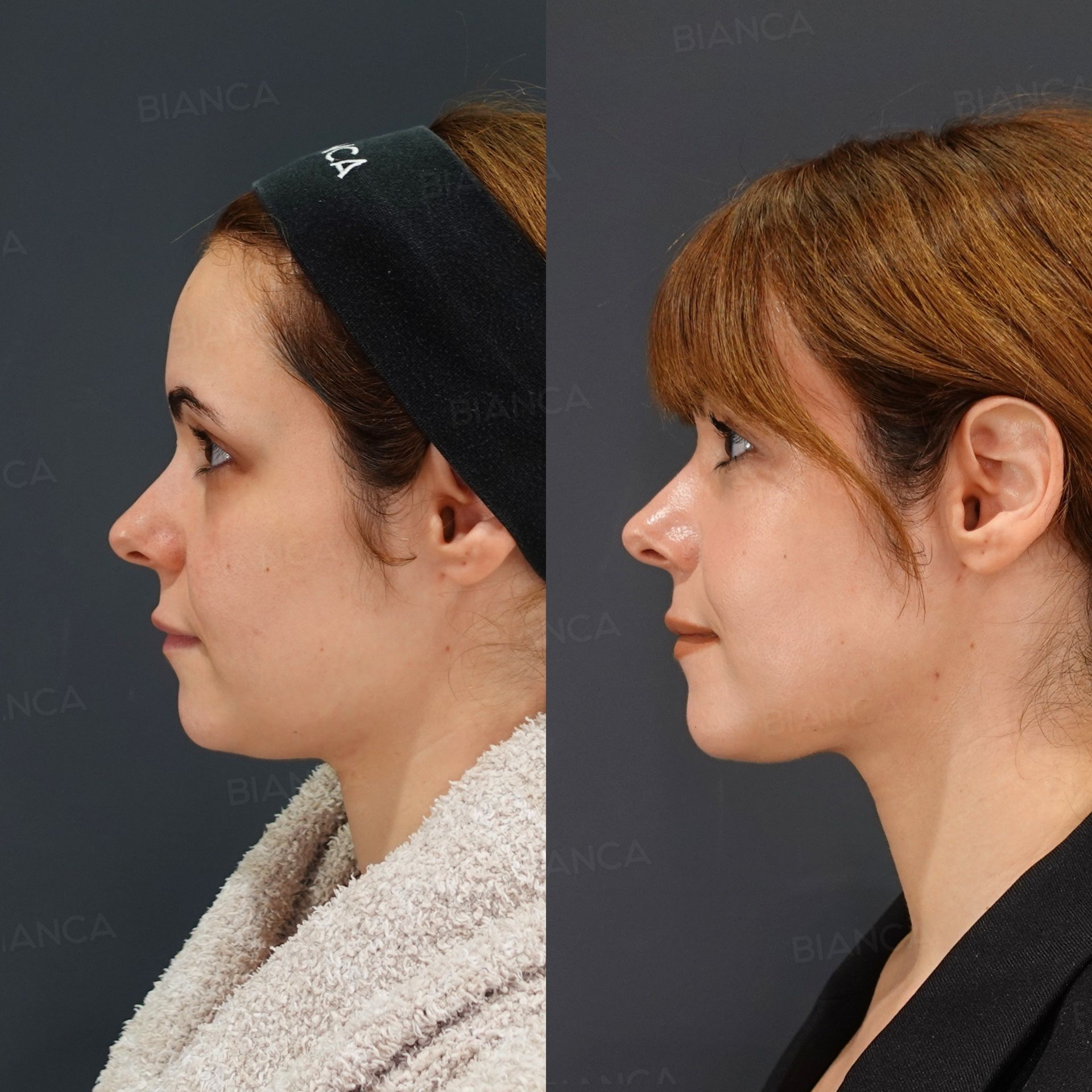 EmbraceRF (Face), Morpheus8 (Submental), Liposuction (Submental)