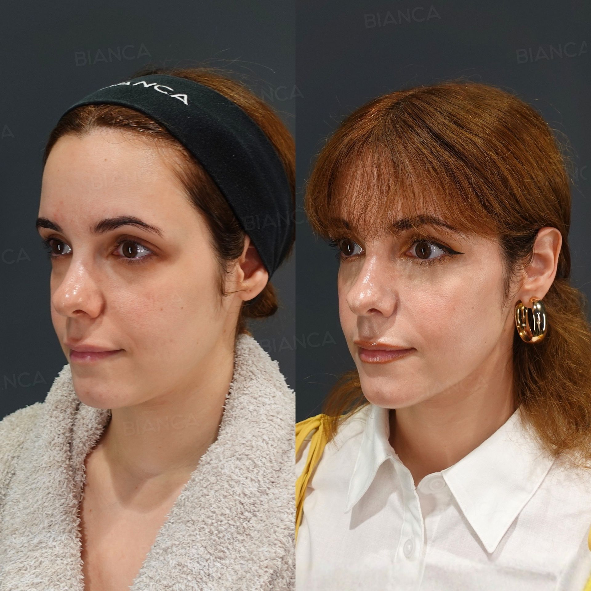 EmbraceRF facial contouring before and after radiofrequency to the face with submental liposuction and Morpheus8, three-quarter view, at 1 month