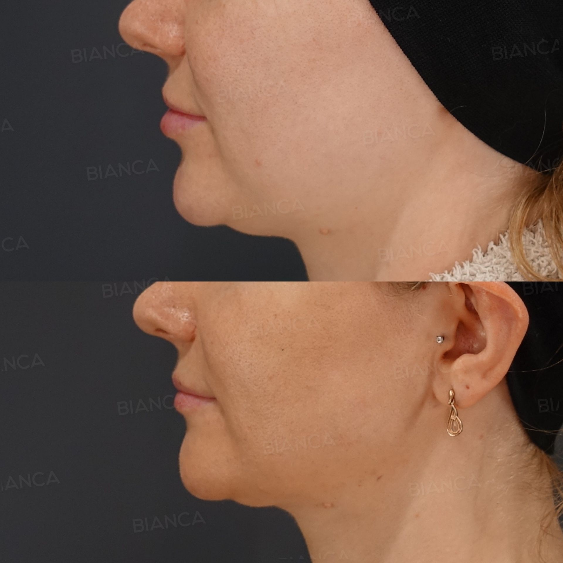 EmbraceRF facial contouring before and after radiofrequency to the lower face and neck with submental liposuction and Morpheus8, side view, at 1 month