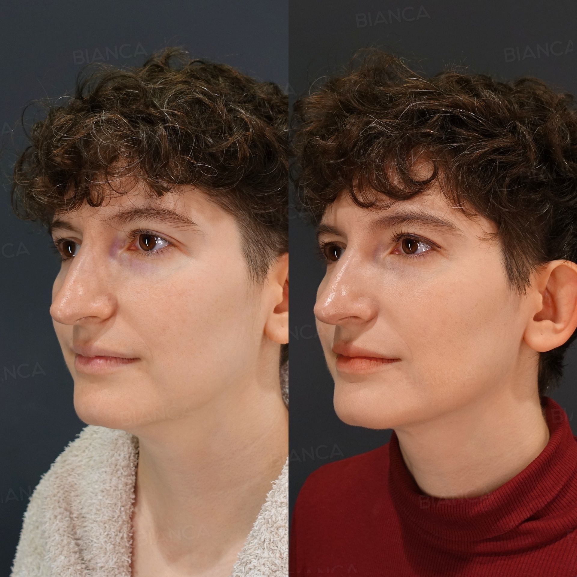 EmbraceRF facial contouring before and after radiofrequency across the face with Morpheus8 and submental liposuction, three-quarter view, at 3 months
