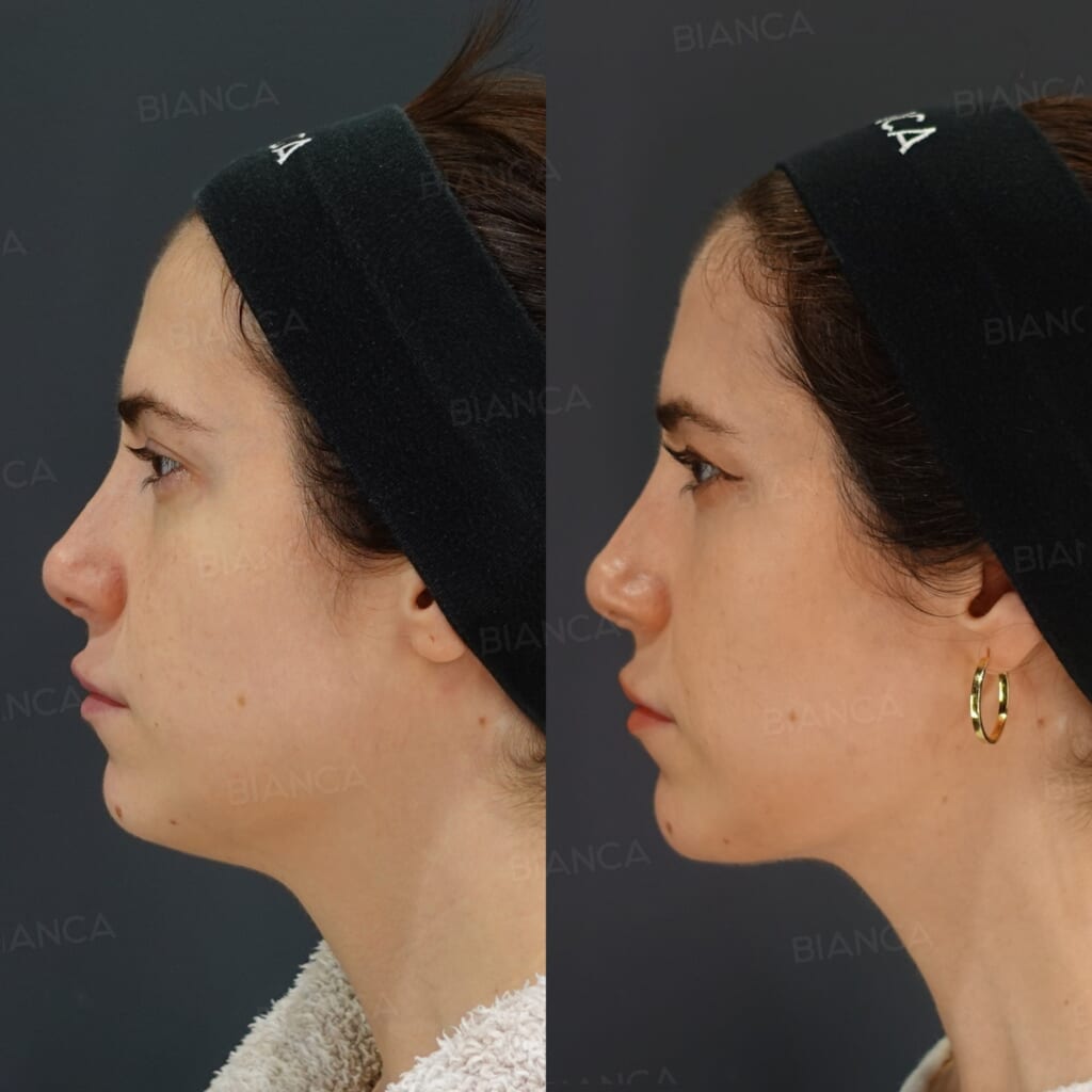 EmbraceRF (Facial Tightening) + VASER Liposuction (Jawline) + Morpheus8 (Submandibular) before and after, 6 months, BIANCA CLINIC Tokyo