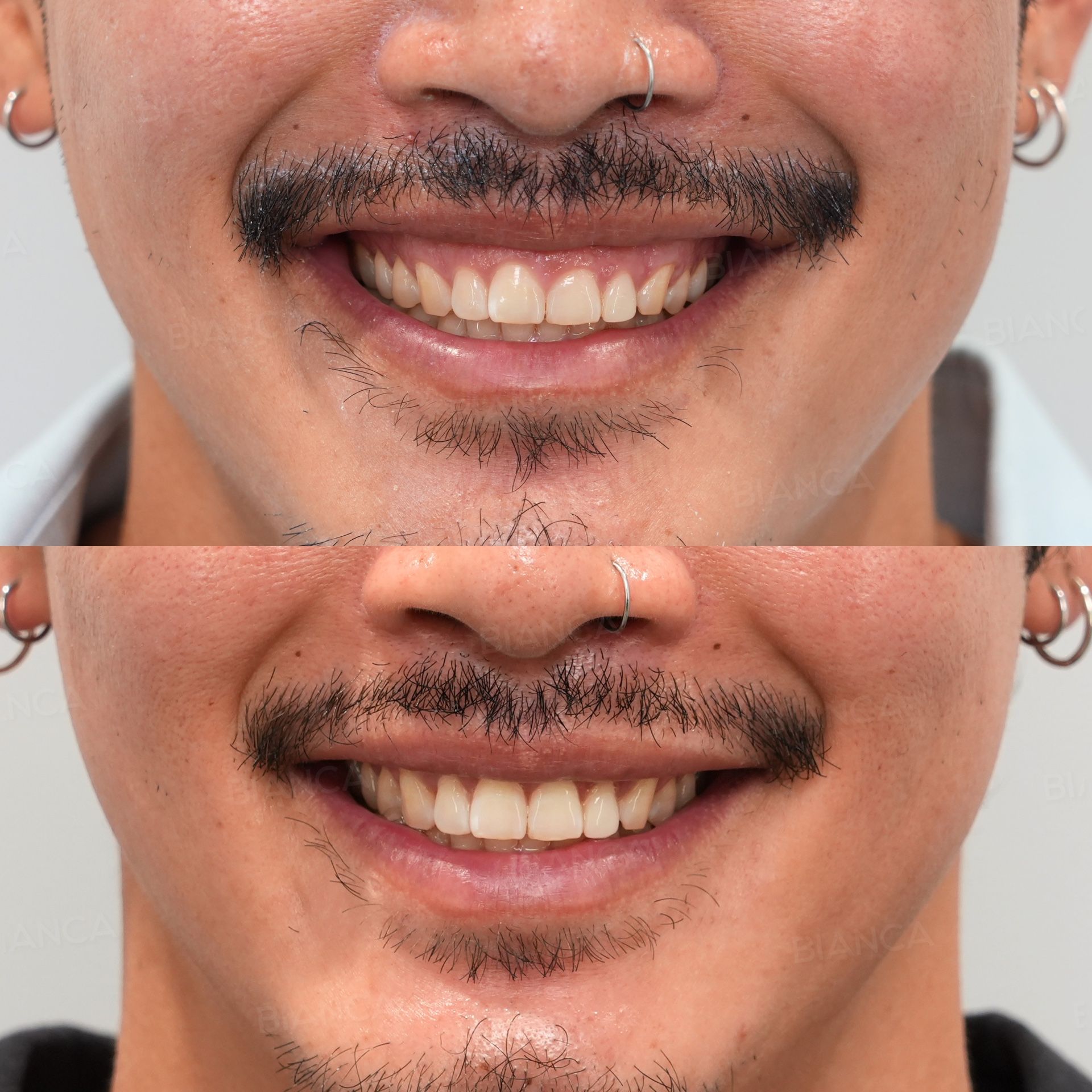 Esthetic crown lengthening before and after reshaping of the gum line for gummy smile correction, front view at 1 month