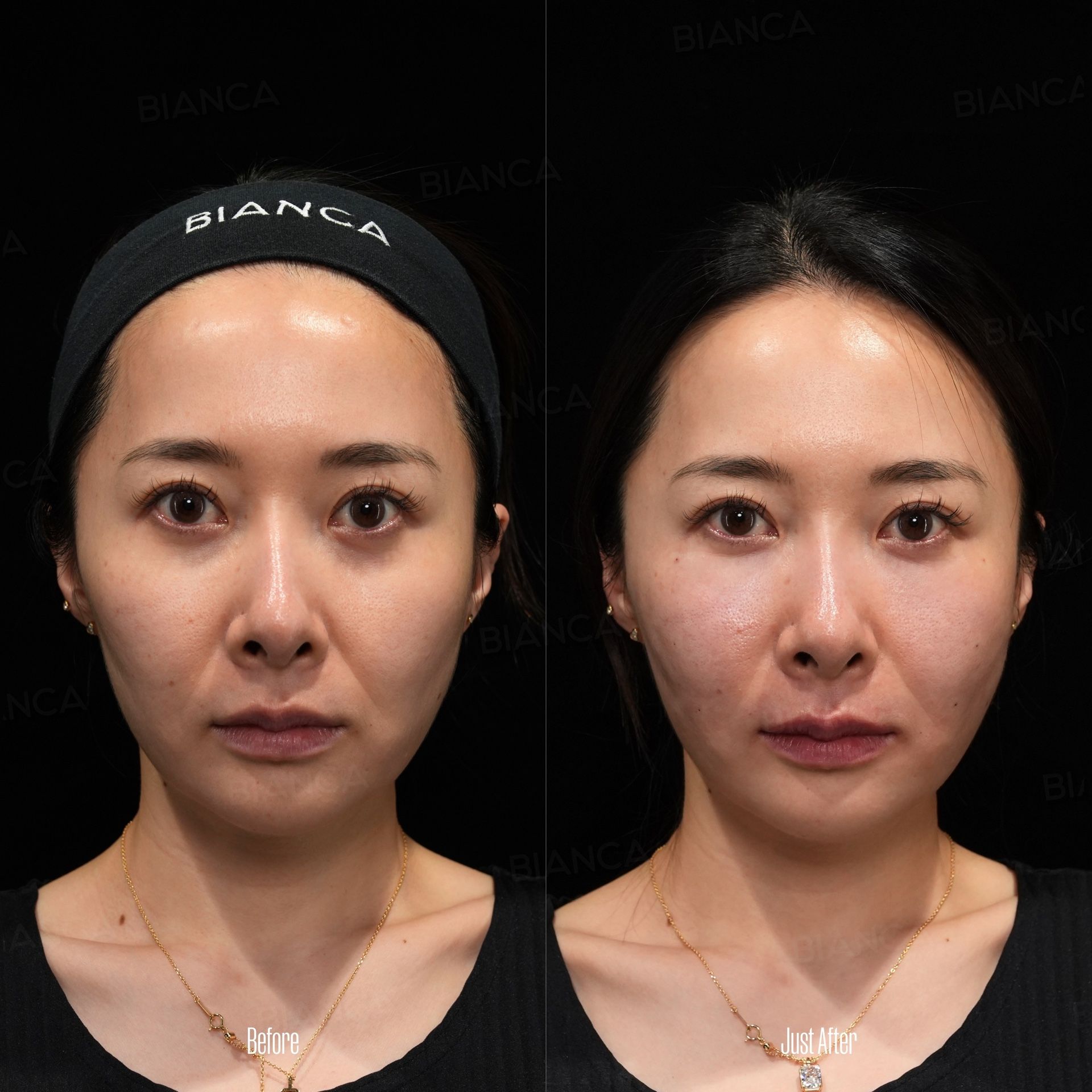 ezGEL (PRF) before and after same visit injection of gel made from the patient's own blood, front view, immediately after treatment