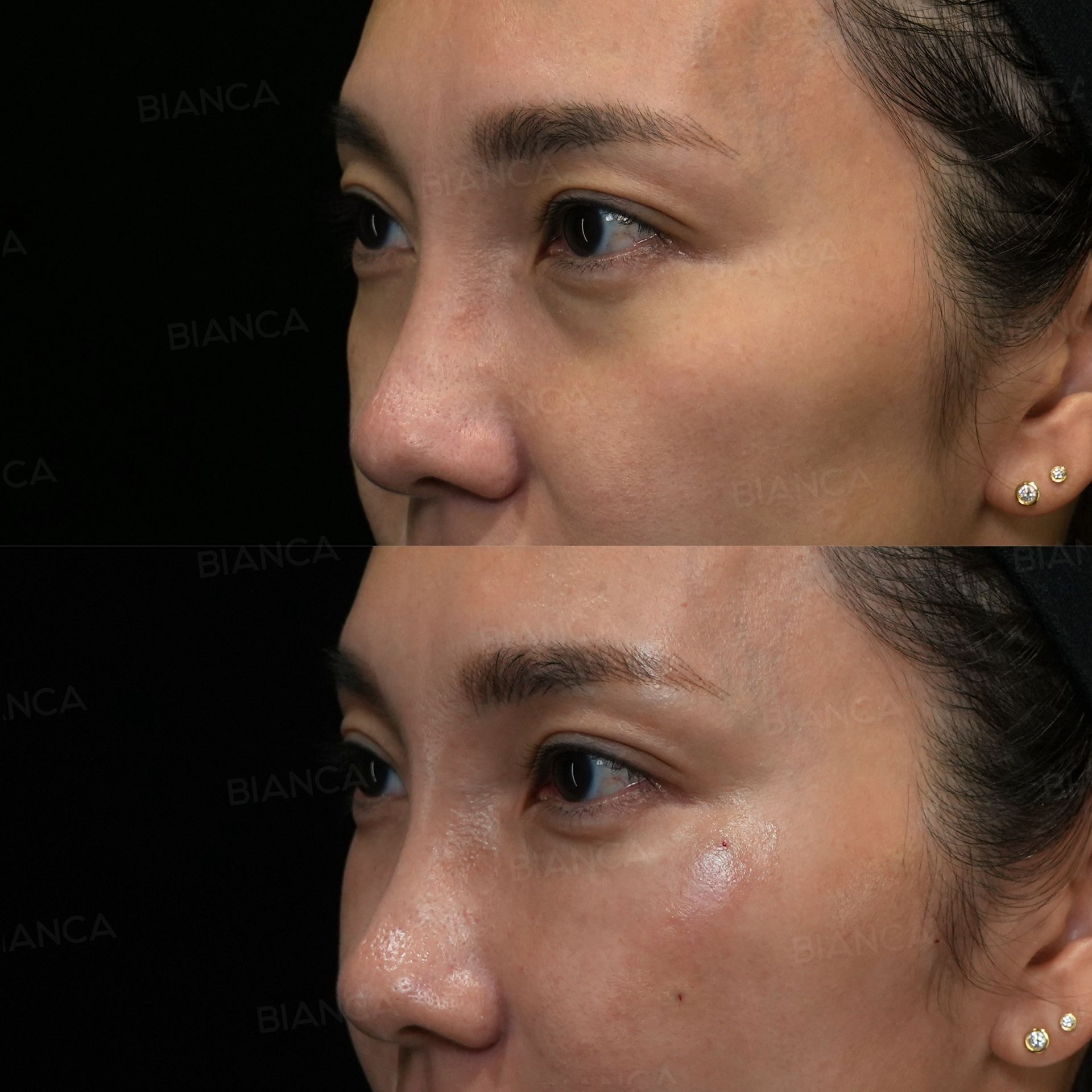 ezGEL (PRF) before and after autologous PRF gel injection, both photographs taken on the same day, three-quarter view, immediately after treatment