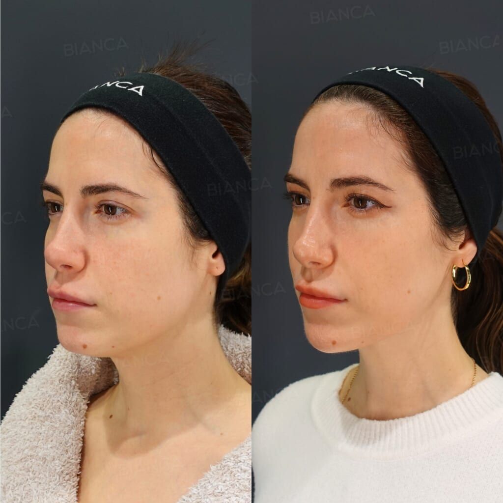 FaceTite (Submental), Liposuction (Submental), Morpheus8 (Submental)