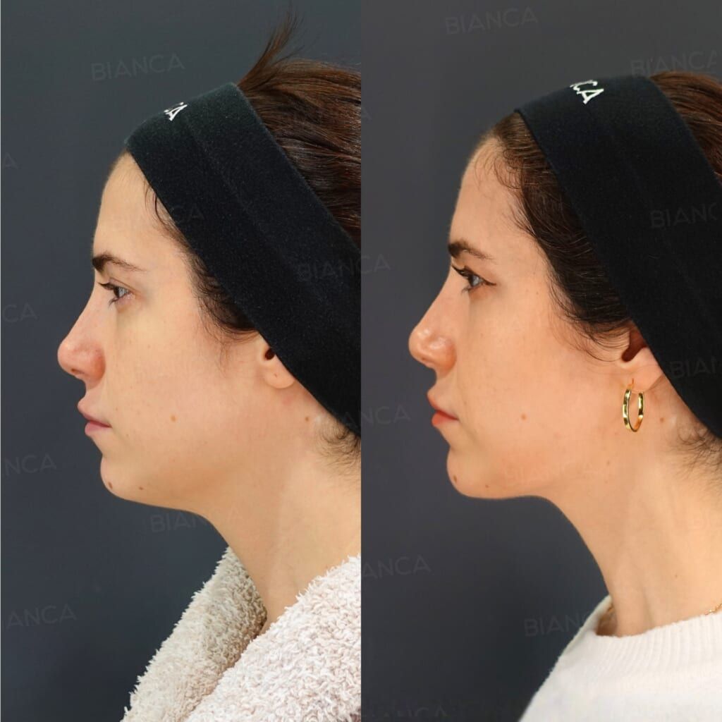 FaceTite (Submental), Liposuction (Submental), Morpheus8 (Submental)