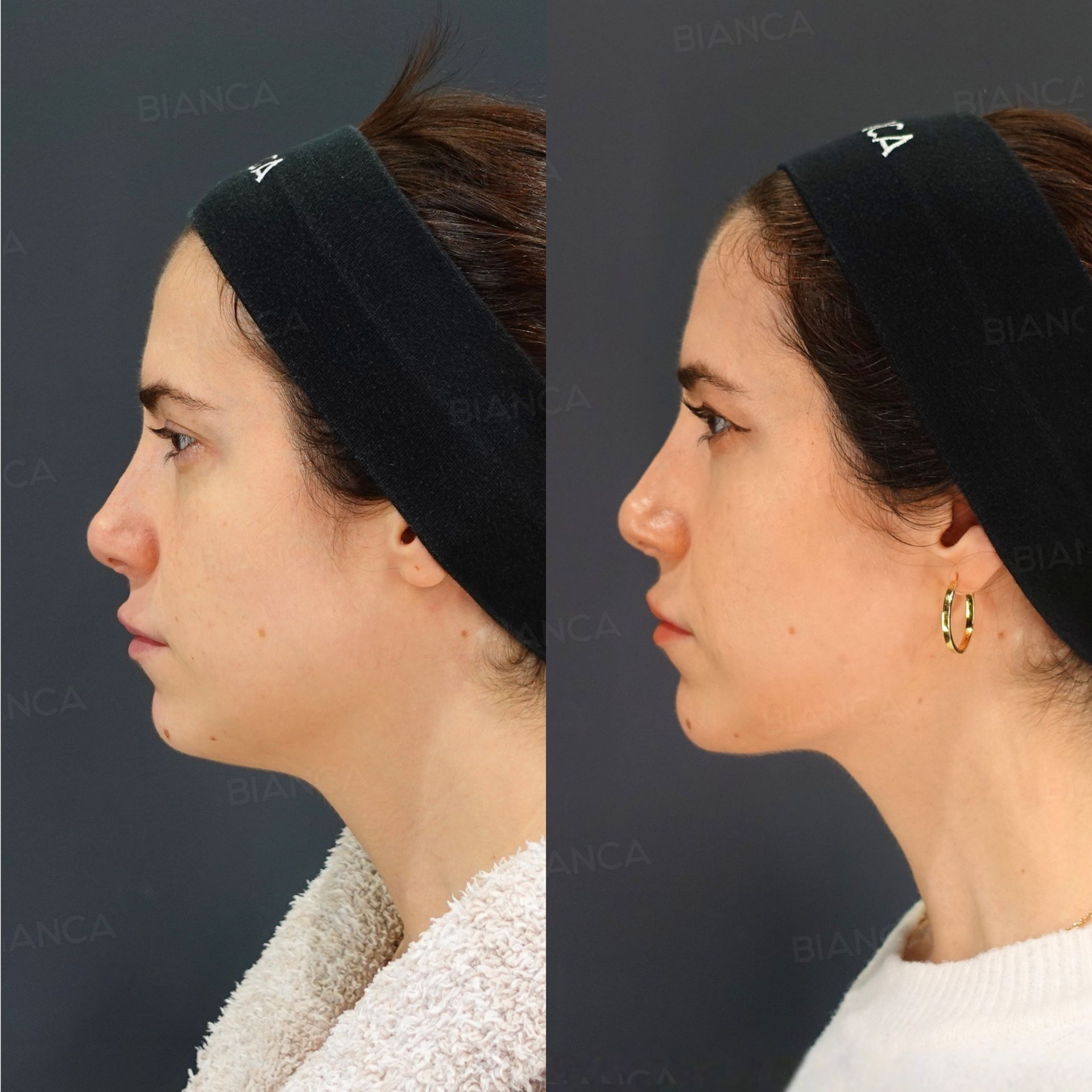 FaceTite (Submental), Liposuction (Submental), Morpheus8 (Submental)